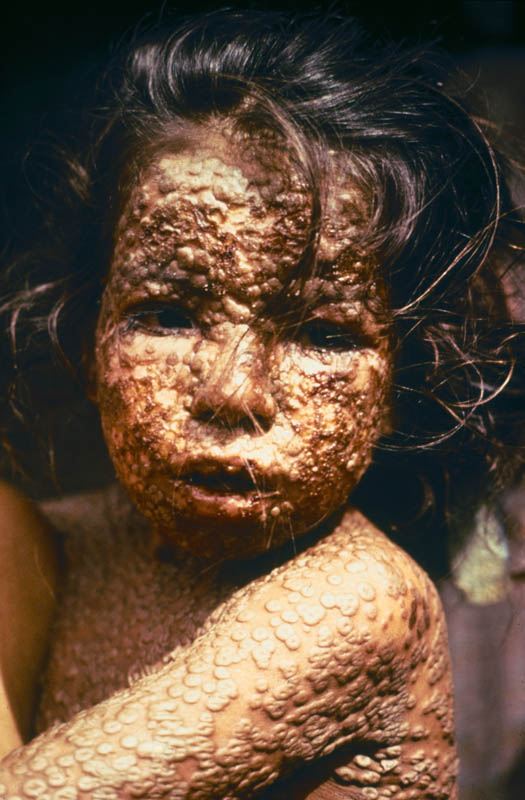 child with smallpox bangladesh This Day In History   October 26th