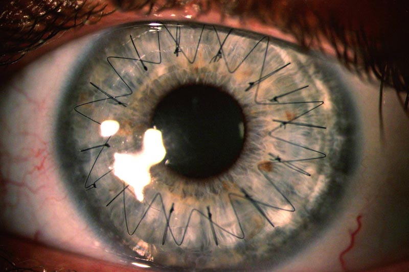 macro close up of stitches insidie eyeball from cornea transplant Picture of the Day: What Stitches in Your Eye Look Like