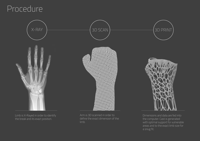 3D printed cast design by jake evill (2)