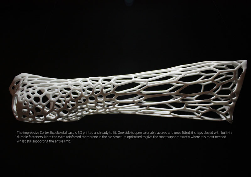 3d printed cast design by jake evill 3 This Revolutionary Membrane Can Keep a Heart Beating Outside of the Body