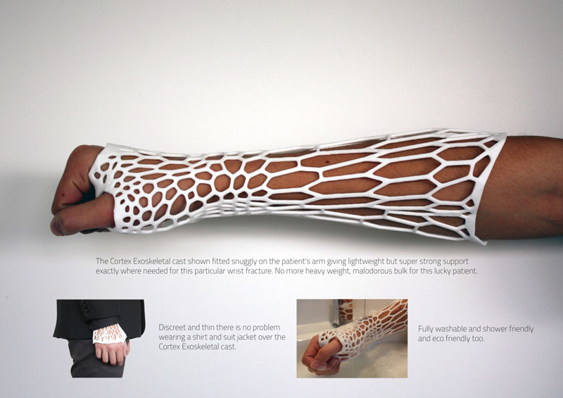 3D printed cast design by jake evill (6)