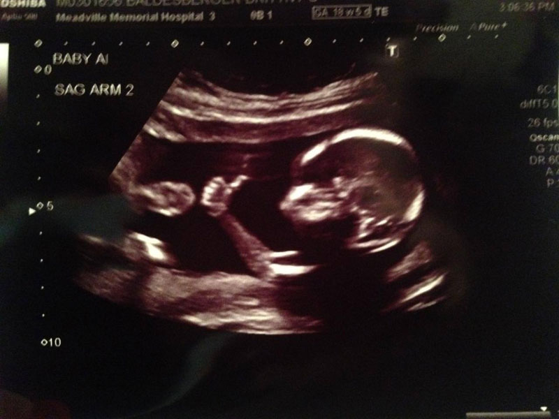 baby gives thumbs up during ultrasound Picture of the Day: Baby Approves Ultrasound
