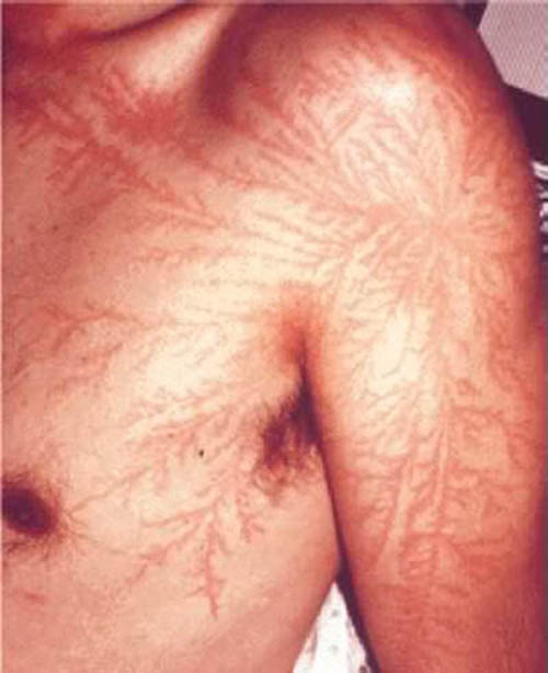 Lichtenberg Figures The Fractal Patterns Of Lightning Strike Scars Twistedsifter 