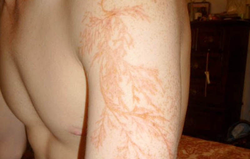 lightning scars on black skin