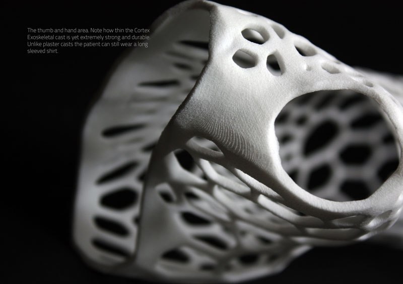 Could This Be the 3D-Printed Cast of the Future? - TwistedSifter