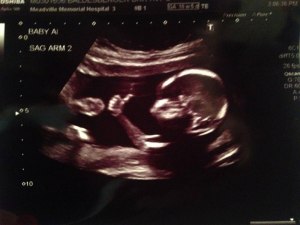 baby gives thumbs up during ultrasound baby gives thumbs up during ultrasound