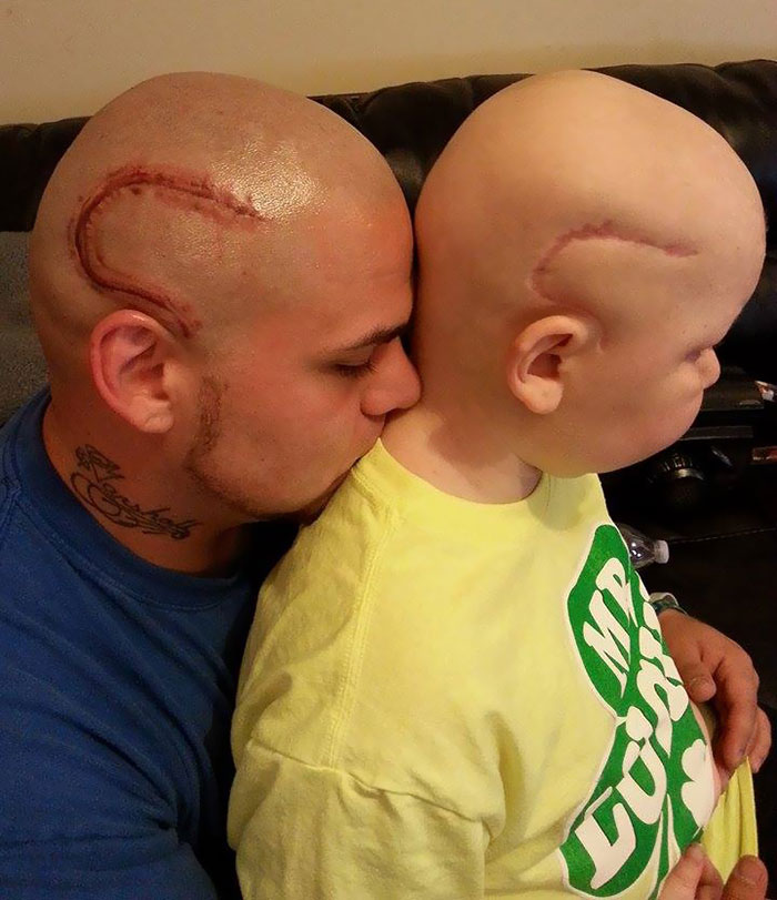 Dad Gets Matching Tattoo of Son's Cancer Scar For Solidarity (4)
