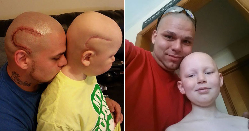 Dad Gets Matching Tattoo of Son's Cancer Scar For Solidarity