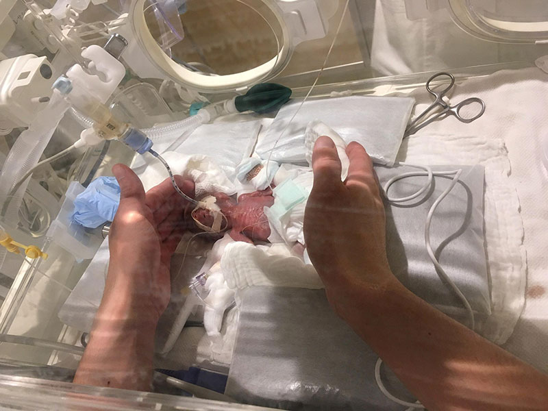 worlds smallest baby 1 Worlds Smallest Boy (Born 268g/9.45oz) Gets Discharged From Hospital