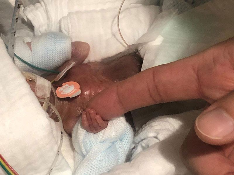 worlds smallest baby 2 Worlds Smallest Boy (Born 268g/9.45oz) Gets Discharged From Hospital