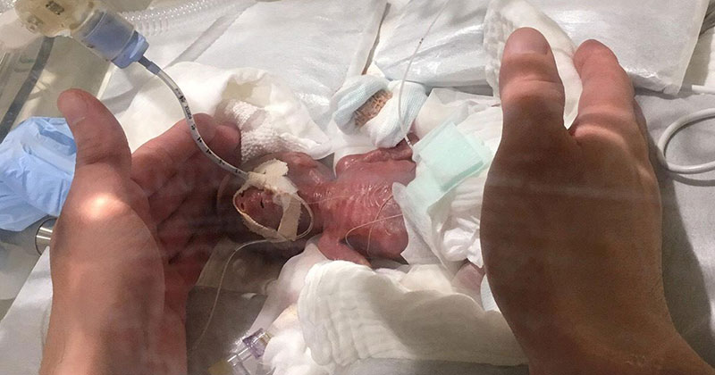 worlds smallest baby 4 Worlds Smallest Boy (Born 268g/9.45oz) Gets Discharged From Hospital