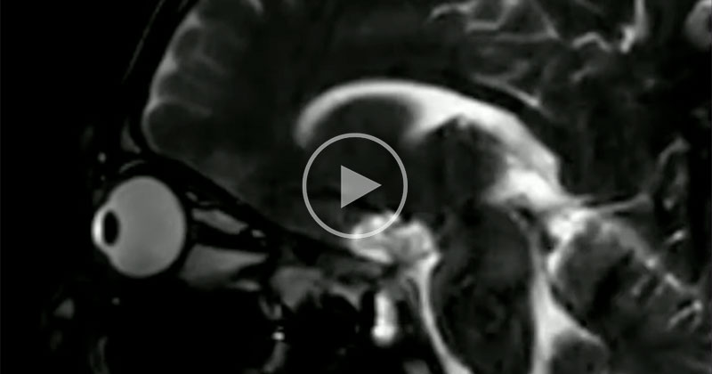 This MRI Shows What Happens When You Rub Your Eyes