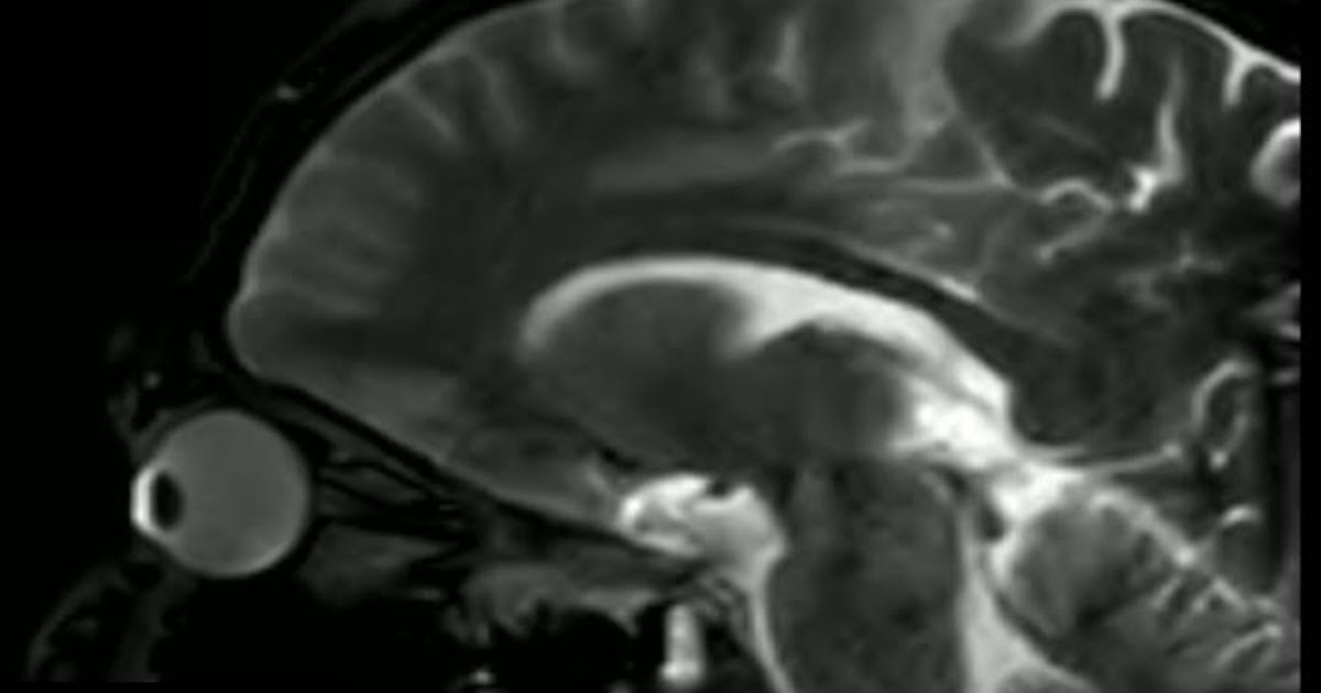 this-mri-shows-what-happens-when-you-rub-your-eyes-twistedsifter