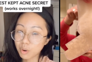 If You Have Acne, You Should Try This Easy Band-Aid Hack