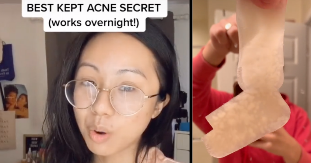 If You Have Acne, You Should Try This Easy Band-Aid Hack