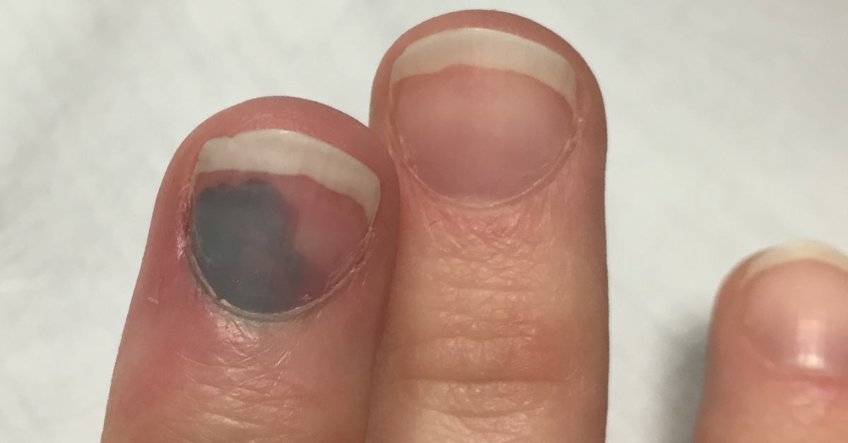 How to get rid of black dots under nails naturally - Quora