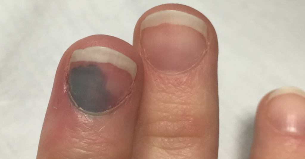 If You Notice Black on Your Nail, This Is Why You Should Go See a Doctor