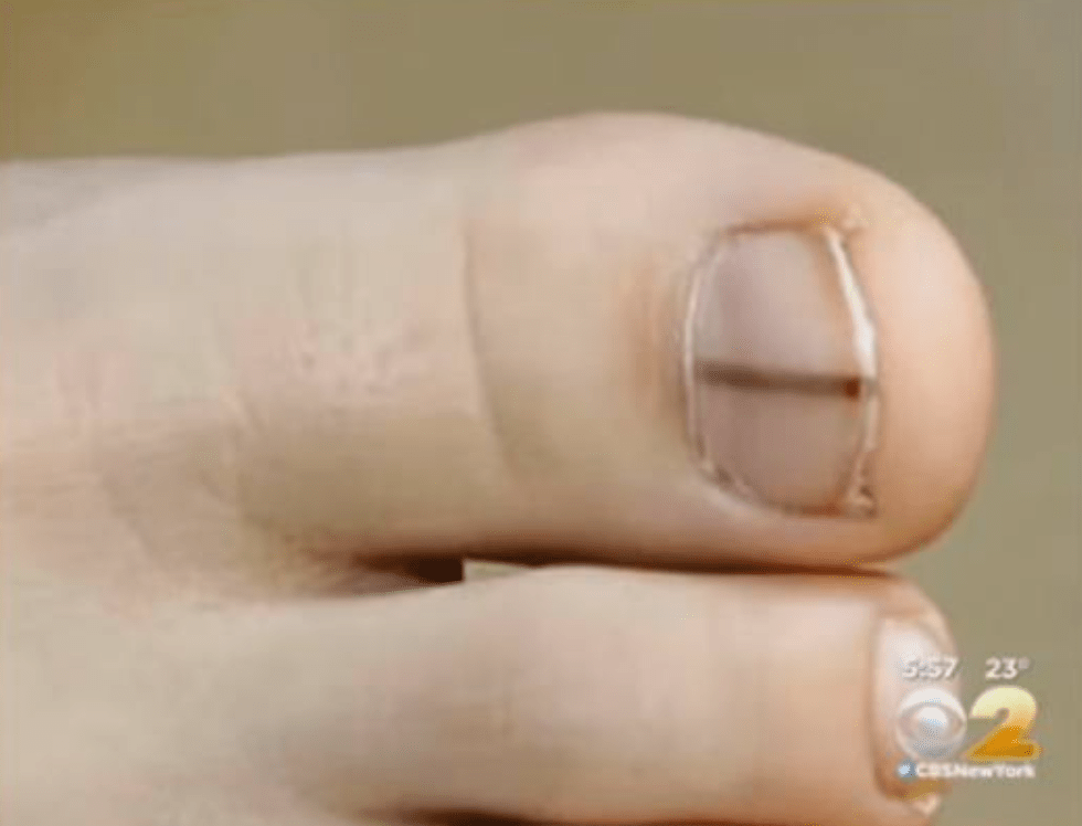 Screen Shot 2022 03 29 at 9.58.32 AM If You Notice Black on Your Nail, This Is Why You Should Go See a Doctor