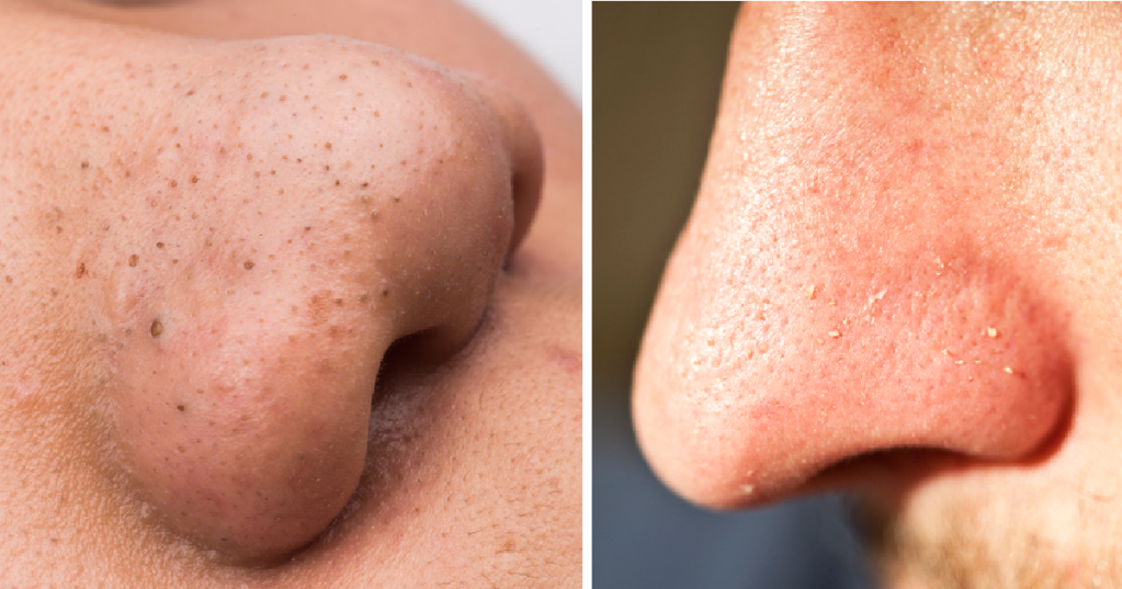 All The Info You Need About The 6 Most Common Types Of Acne