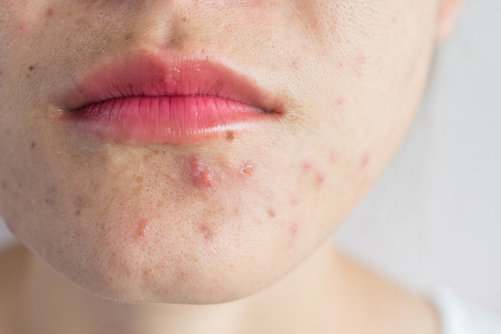 iStock 1185230818 All The Info You Need About The 6 Most Common Types Of Acne