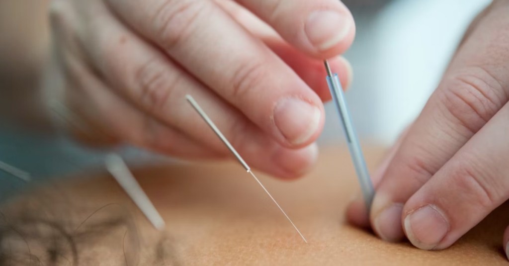 Doctor Talks About the Potential for Pain Relief From Dry Needling Treatment