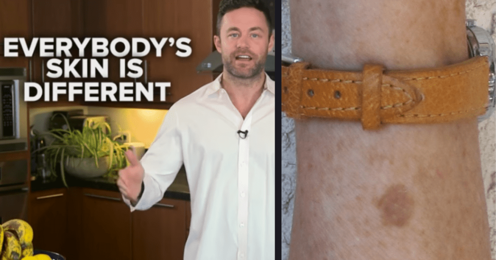 Try This Trick to Remove Brown Spots From Your Skin