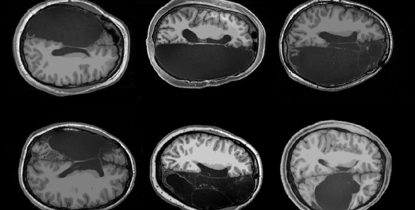 study-finds-you-can-still-recognize-names-and-faces-with-half-a-brain