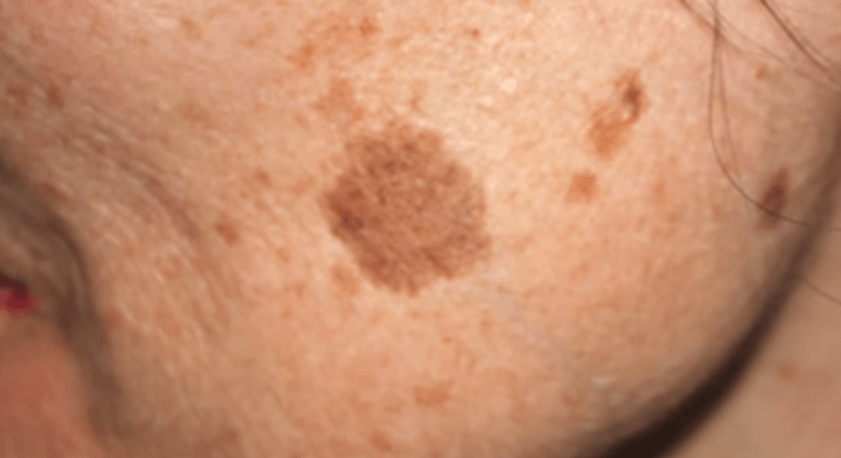 why-do-you-get-dark-spots-on-your-skin-youtube