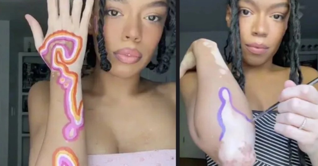 Woman With Vitiligo Uses Her Skin to Create “Art Spots” and People Love It