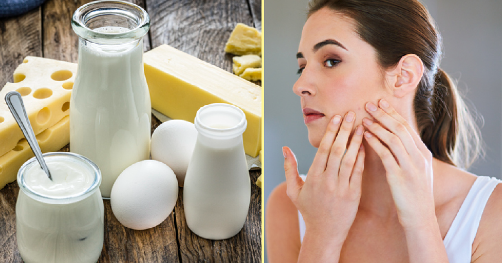 The Truth About Whether Or Not Milk Causes Acne