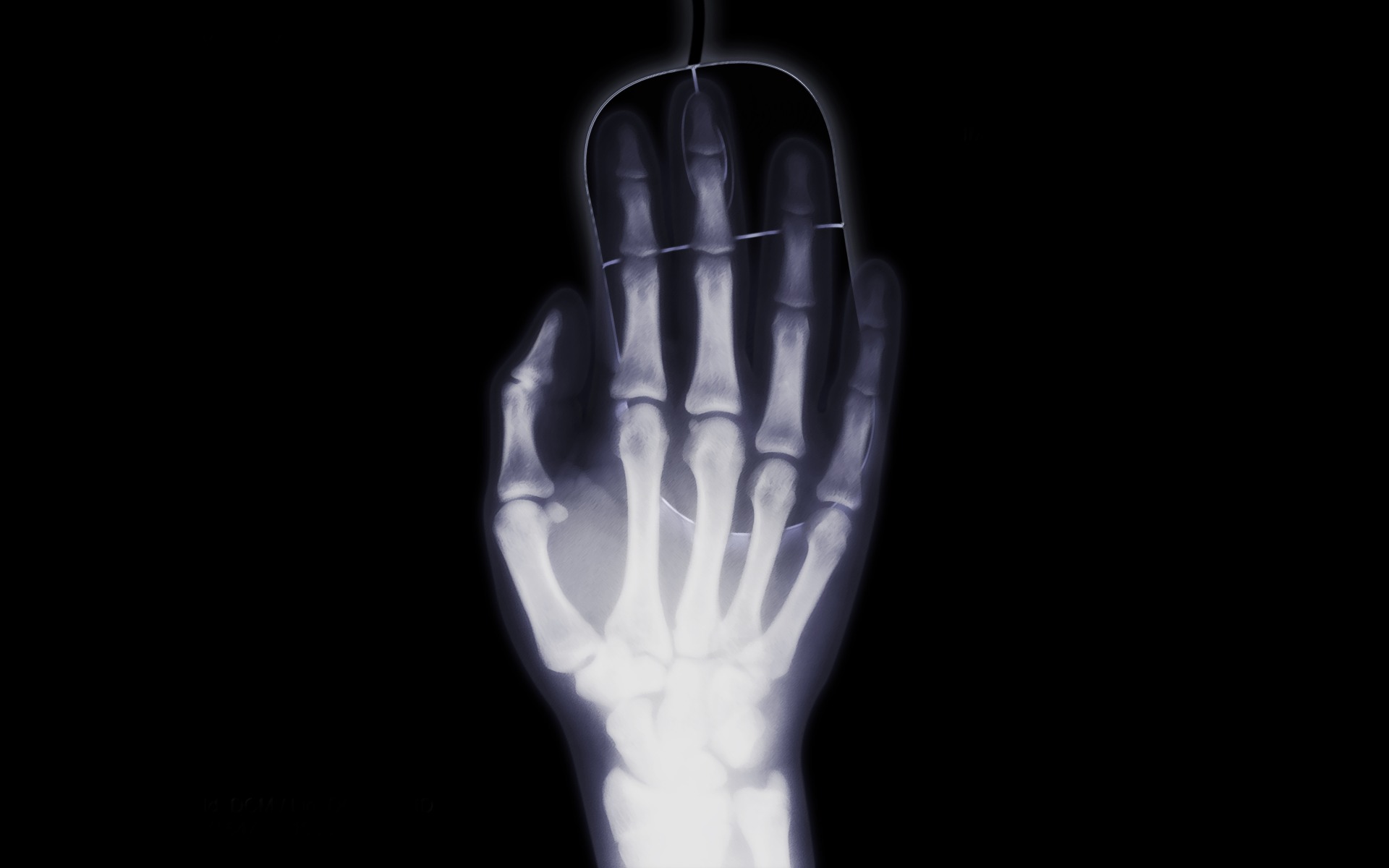 Hand x ray thumbnail Newly Discovered Bacteria May Be a Culprit in Rheumatoid Arthritis