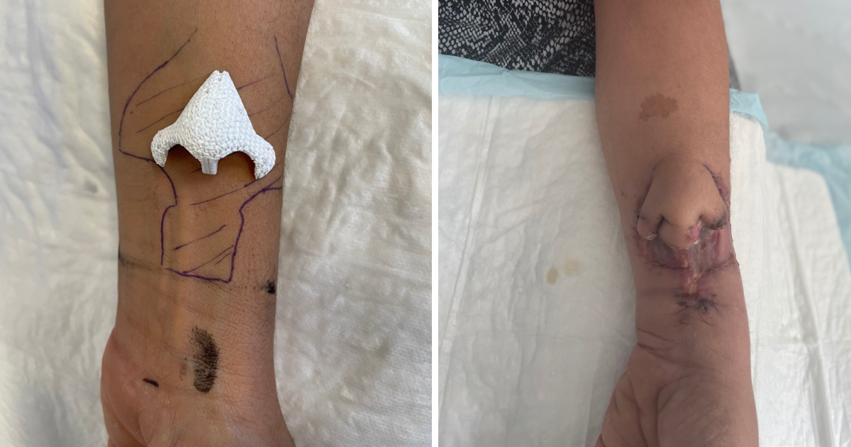 Doctors Successfully 3D Printed This Cancer Patient A New Nose