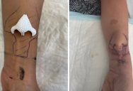 Doctors Successfully 3D Printed This Cancer Patient A New Nose