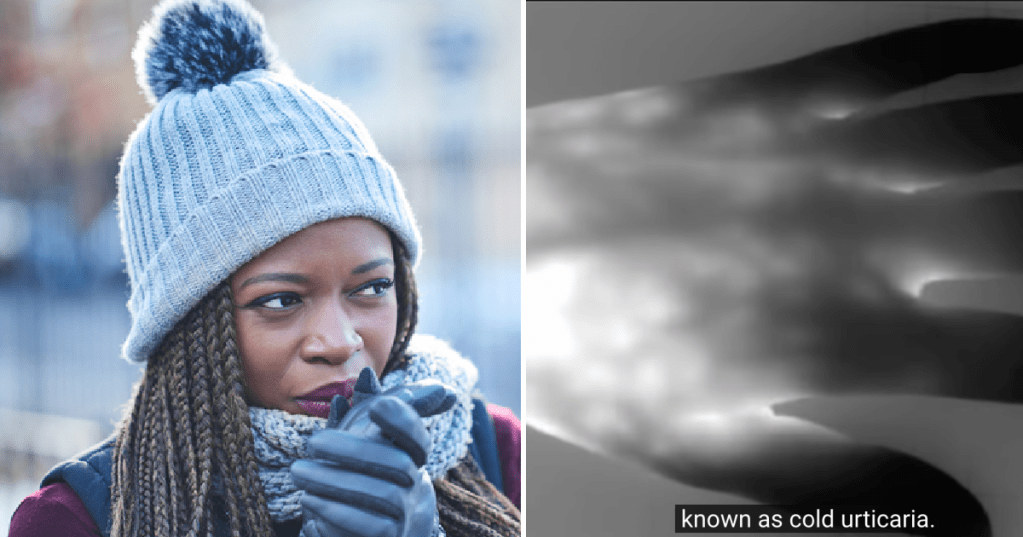 Is It Possible To Be Allergic To The Cold?