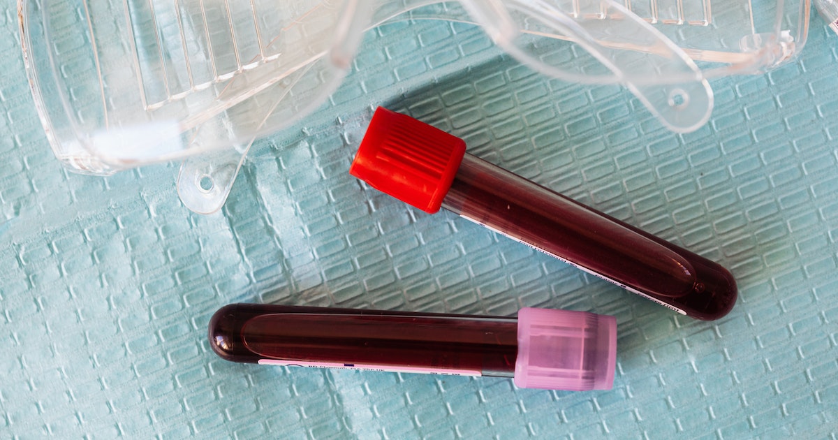 Alzheimers blood vials featured image New Blood Test May Eliminate Scans to Detect Alzheimer’s Disease