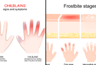 Knowing The Differences Between Chilblains And Frostbite Could Save Your Fingers