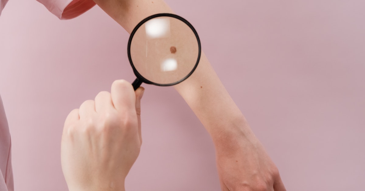 Skin cancer featured image Highly encouraging New mRNA Test Results for Treating Skin Cancer