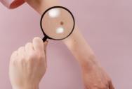 “Highly encouraging” New mRNA Test Results for Treating Skin Cancer