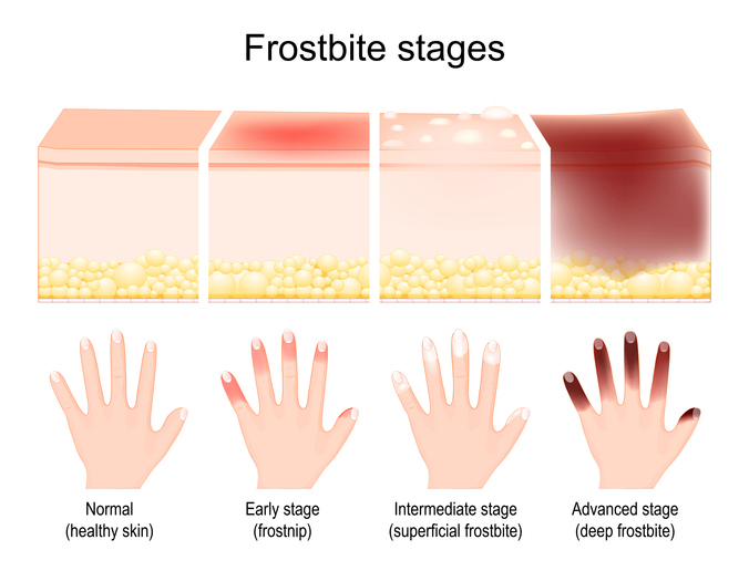 iStock 1406709791 Knowing The Differences Between Chilblains And Frostbite Could Save Your Fingers