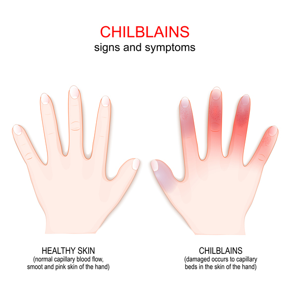 iStock 1407844079 Knowing The Differences Between Chilblains And Frostbite Could Save Your Fingers