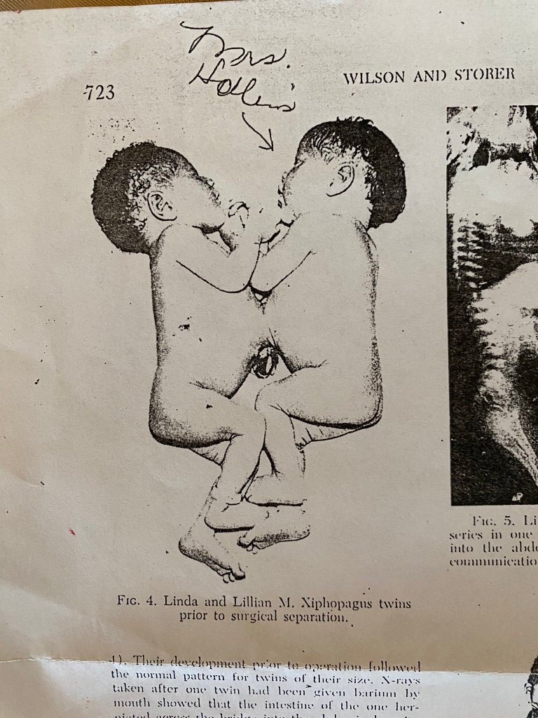 FqQNFhqWwAQoKw  Separated in 1955, Conjoined Twins Talk About Life After Surgery