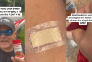 ‘This is what I keep in my first aid kit.’ TikToker Shows How Meat Tenderizer Can Neutralize Painful Stings & Bites From Bugs