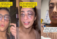 ‘I can’t see properly.’ A Woman Talked About The Severe Allergic Reaction She Had And People Were Surprised She Was So Calm