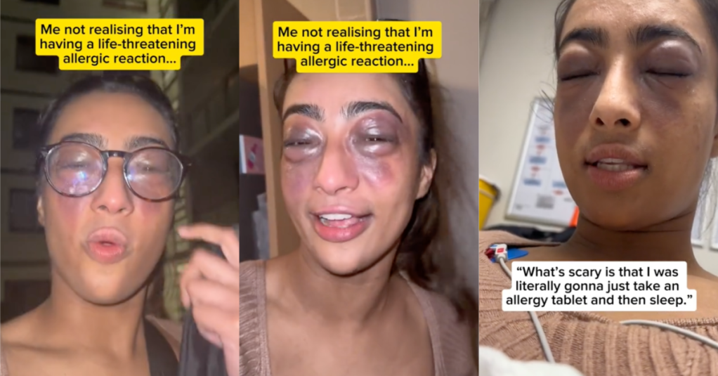 'I can't see properly.' A Woman Talked About The Severe Allergic Reaction She Had And People Were Surprised She Was So Calm
