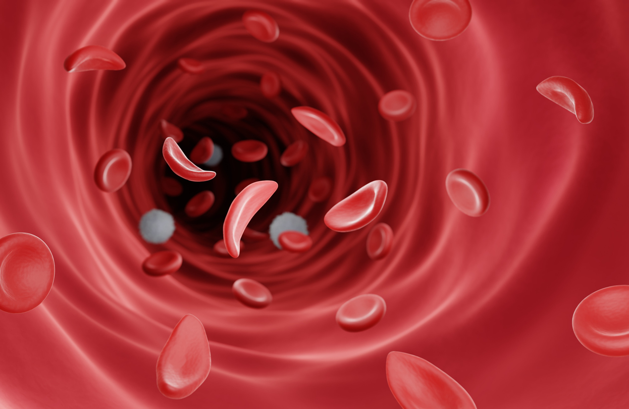 iStock 1385972210 How A Five Year Old Was Cured Of Sickle Cell Anemia.   Definitely saved his life.