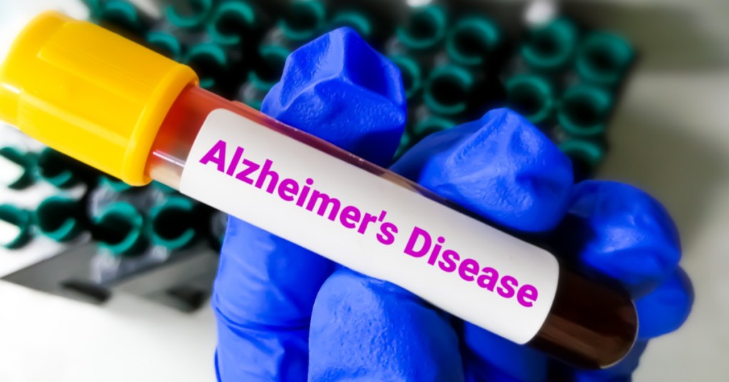New Theory Could Be A Turning Point For Alzheimer's Research