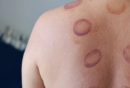 What Are The Dark Circles Some Swimmers Have On Their Backs? It’s Called Cupping And It Has Been Used In Medicine Since 1550 BCE.