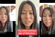 Doctor Talked To Viewers About The Dangers Of Fatty Liver Disease And What Causes It. – ‘High blood pressure, high cholesterol, diabetes, or obesity.’