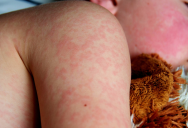 Disturbing New Report From World Health Organization Finds A 20% Spike In Cases Of Measles Worldwide Resulting In Over 100,000 Fatal Cases