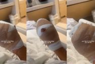 Hospital Patient Issues Warning About Nail Biting After She Need Minor Surgery To Wipe Out The Bacteria